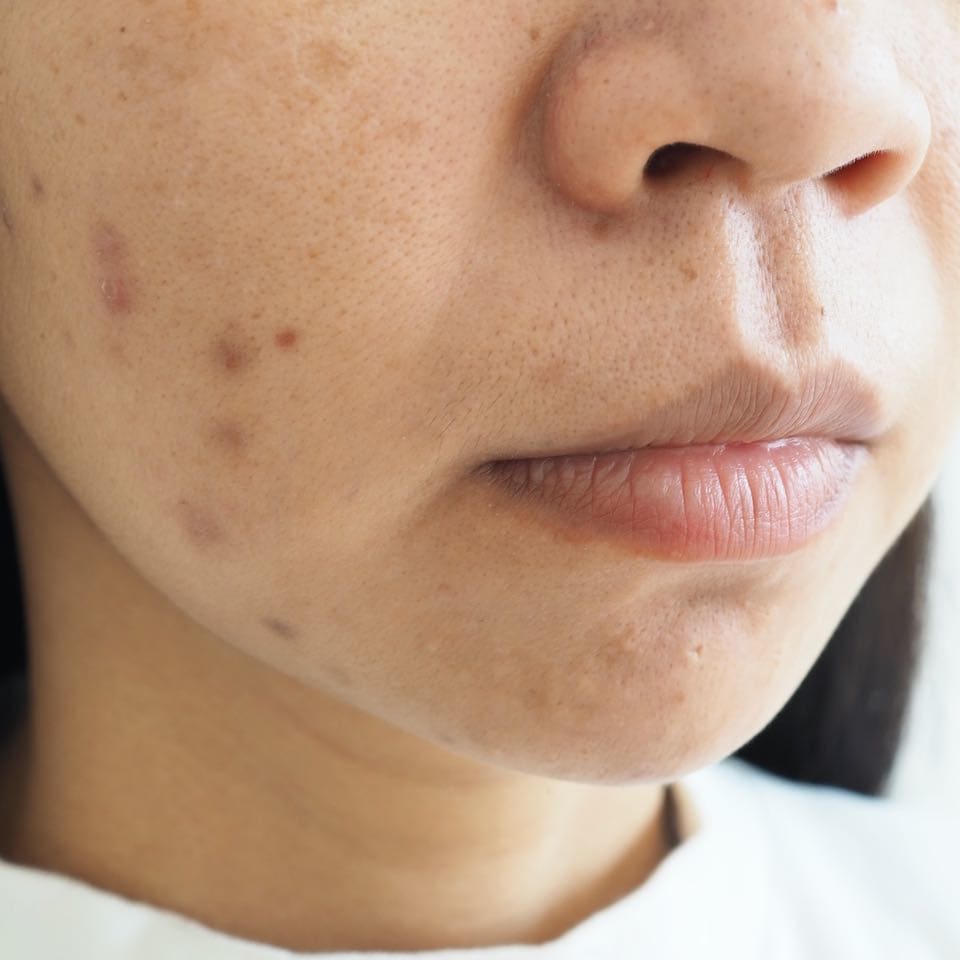 How To Treat Post-Inflammatory Hyperpigmentation Caused By The AEDITION