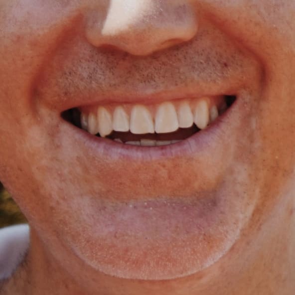 Can You Instantly Straighten Your Teeth with Veneers?