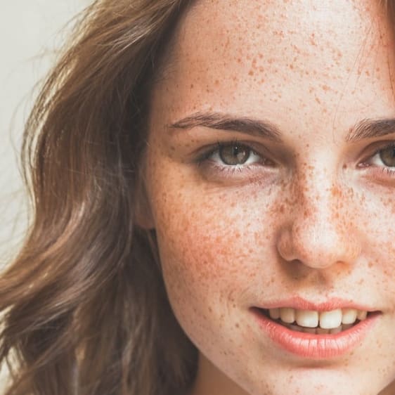 What's The Difference Between Freckles And Sun Spots?