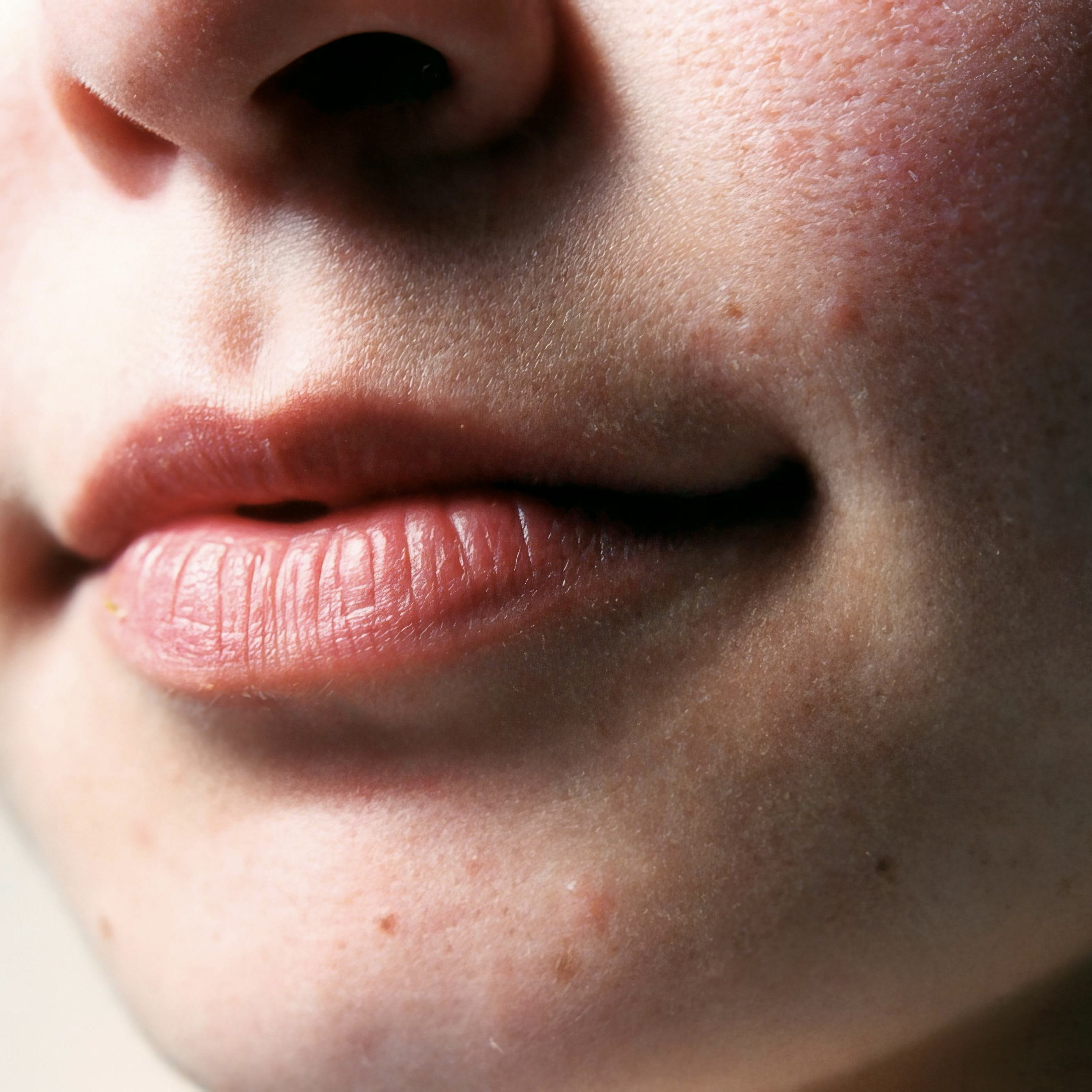 Rosacea 101: Types, Triggers & Treatments