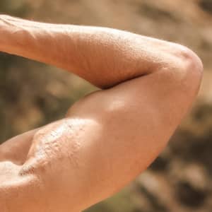 Arm Lift (Brachioplasty)