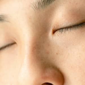 Blepharoplasty