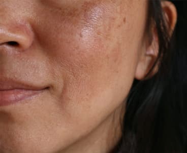 The Ultimate Guide To Dark Spots And Hyperpigmentation