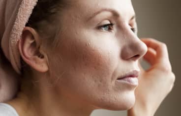 How To Treat Acne Scars