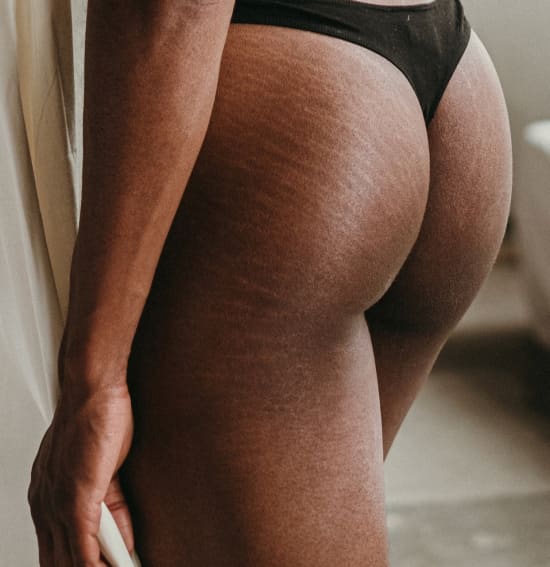Every Treatment And Procedure That Helps Minimize Stretch Marks