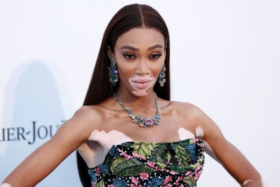 Everything You Need To Know About Vitiligo