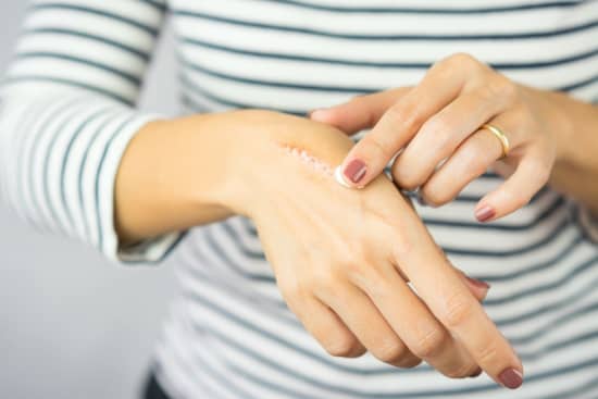 Everything You Need To Know About Treating Burns