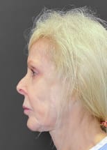 Facelift Before, Female 67 - 4225