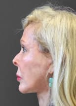 Facelift After, Female 67 - 4225