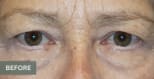 Upper Eyelid Blepharoplasty Before, Female 63 - 4864