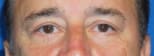 Blepharoplasty After, Male 55 - 2624