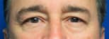 Blepharoplasty Before, Male 55 - 2624