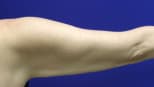 Arm Lift Before, Female 39 - 3041
