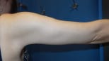 Arm Lift After, Female 39 - 3041