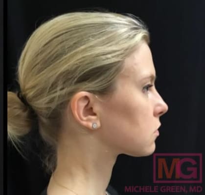 Botox After, Female 32 - 1099