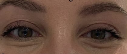 Botox After, Female 26 - 1822