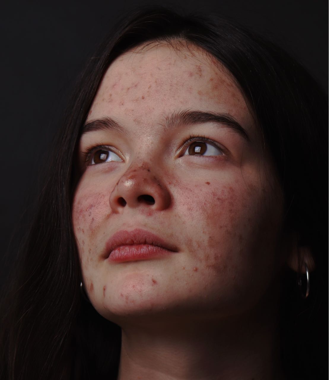 Oily Skin vs. Acne-Prone Skin: What’s The Difference?