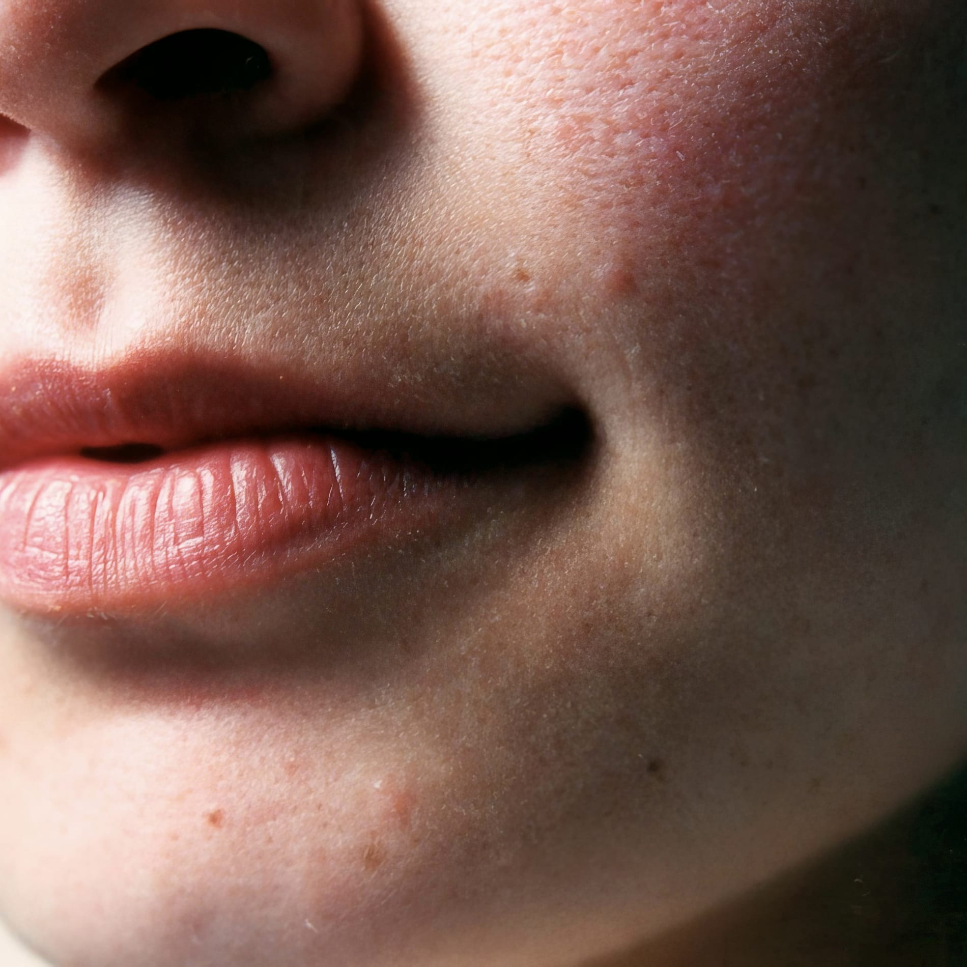 A detailed close-up of a person’s lower face showing early signs of rosacea, visible redness, small bumps, and uneven skin texture on the cheeks and chin, commonly associated with rosacea flare-ups.