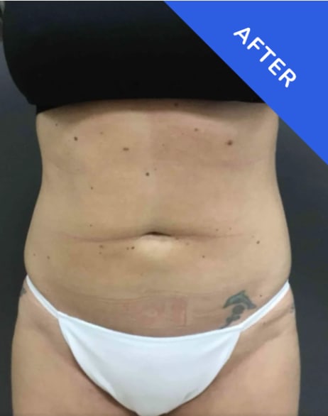 Abdominoplasty – la Belle vie