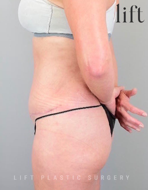 Do Tummy Tucks leave scars? Busting Abdominoplasty Myths