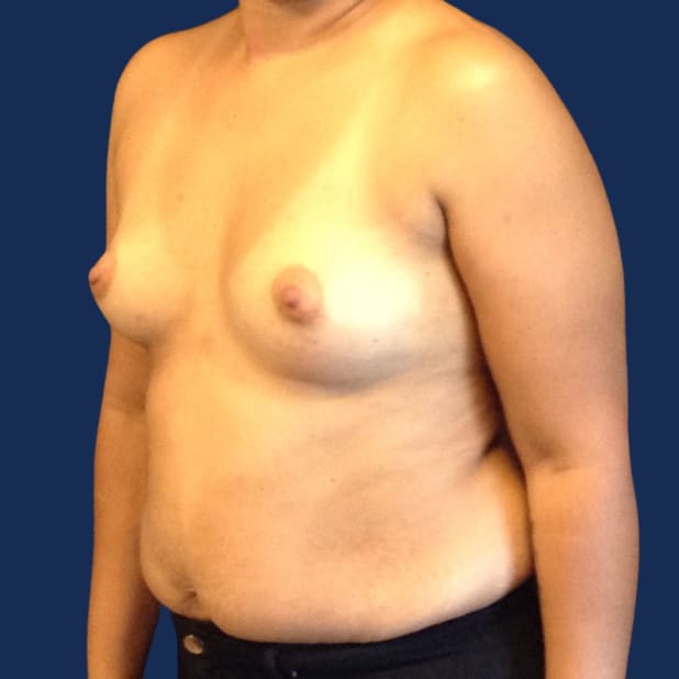 Asymmetrical Breasts Correction  Scottsdale AZ Female Plastic Surgeon