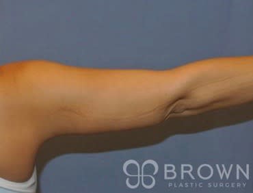 Arm Slimming Solutions Overview: Cost, Recovery, Before & After