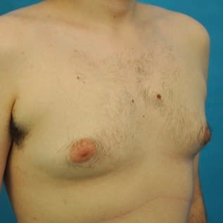 gynecomastia,droopy male breasts,skin removal,lift - New Gynecomastia