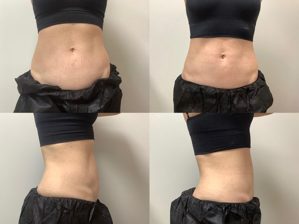 I Tried A Body Contouring Treatment--These Are My Results