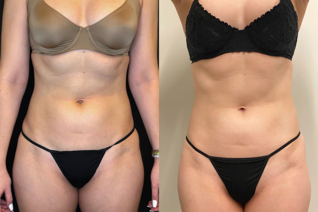 Emsculpt NEO Before and After