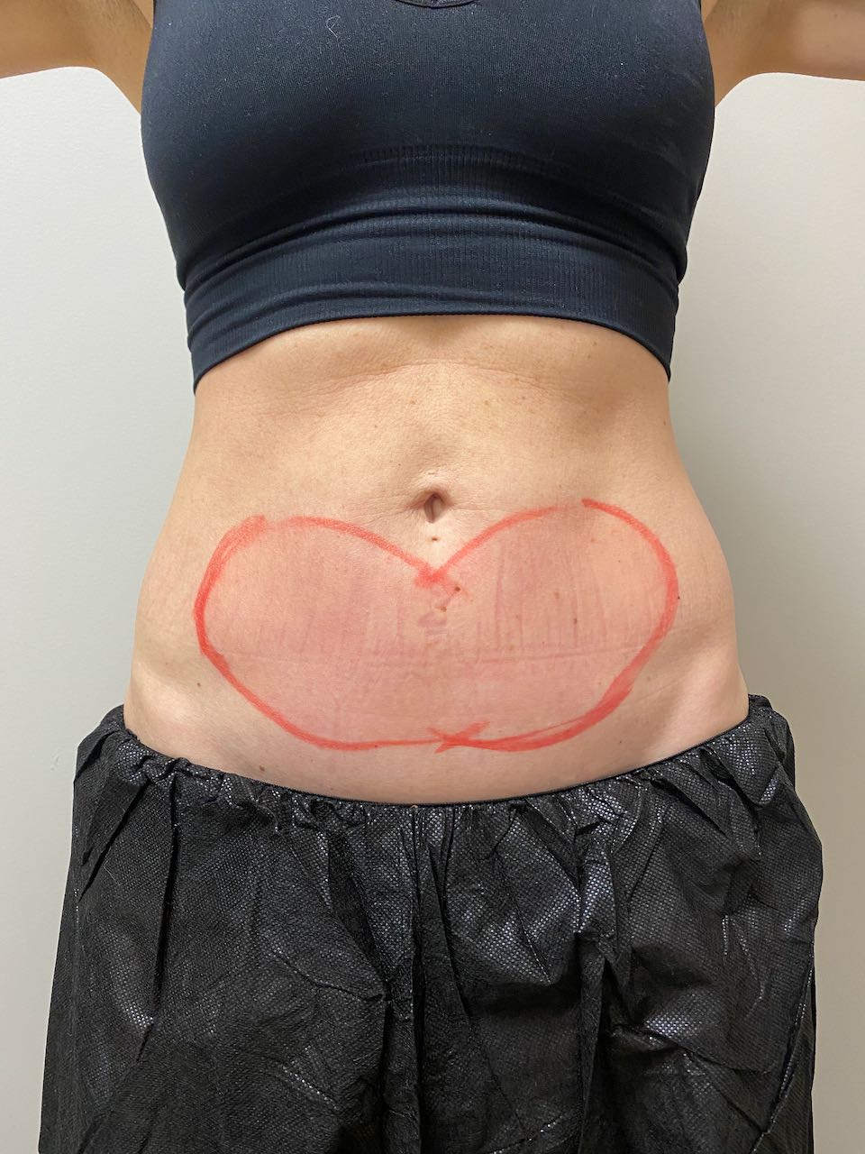 CoolSculpting Before and After Pictures - Female Stomach