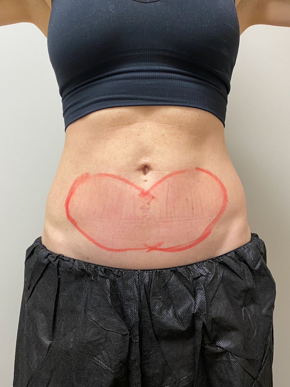 CoolSculpting Before and After