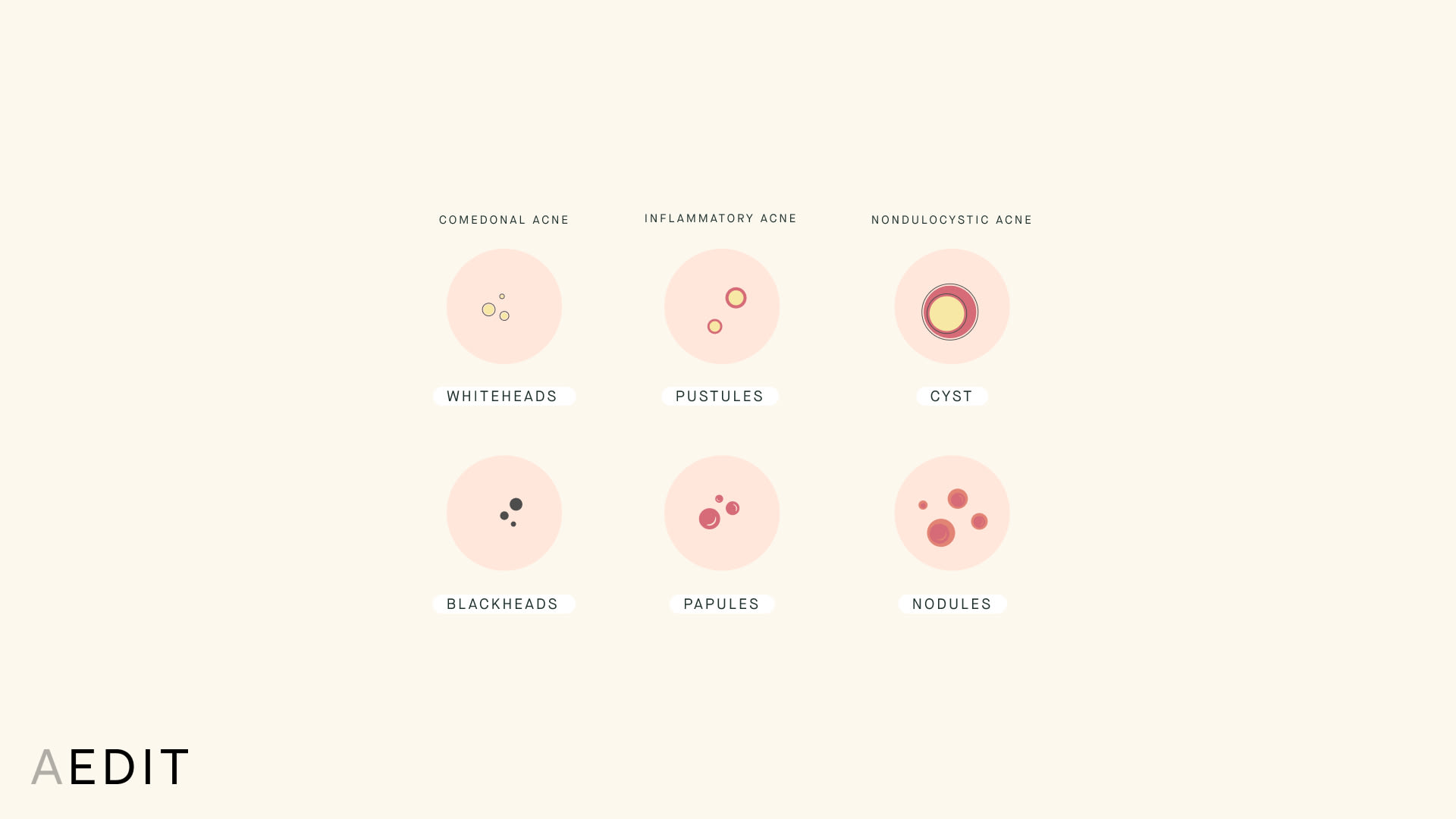 Types of Acne Illustration Comedonal Inflammatory Cystic on Fair Skin