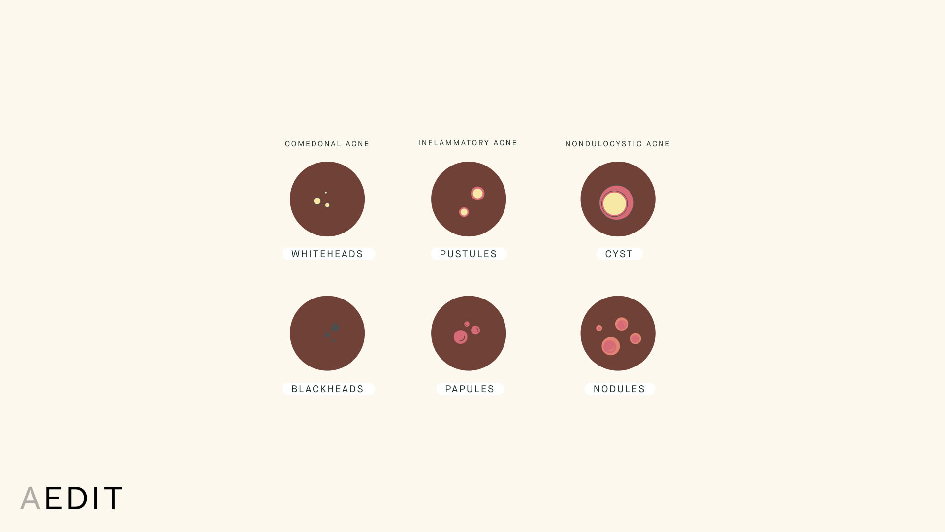 Types of Acne Illustration Comedonal Inflammatory Cystic Dark Skin