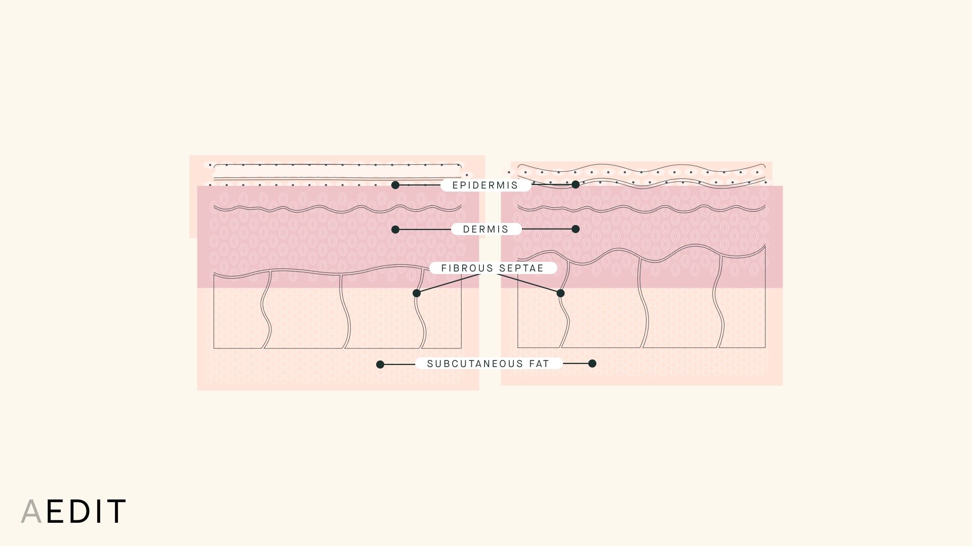 Cellulite Anatomy Illustration