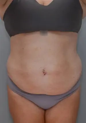 Abdominoplasty Before, Female 40 - 4521