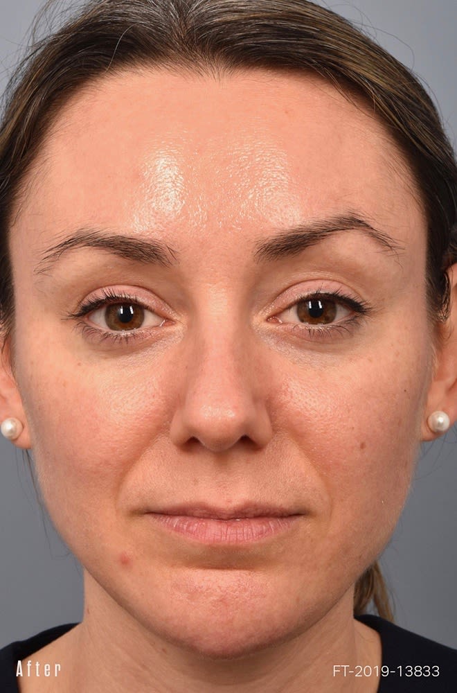 Skin Smoothing Solutions After, Female 34 - 1845