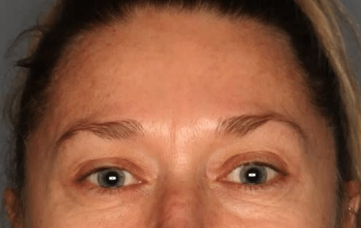 Blepharoplasty Before, Female 45 - 1014