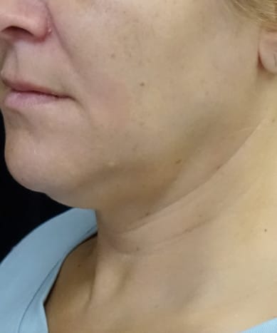 Kybella® Before, Female 56 - 3792