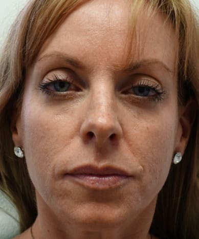 Dermal Filler & Injectable Solutions Before, Female 44 - 3791