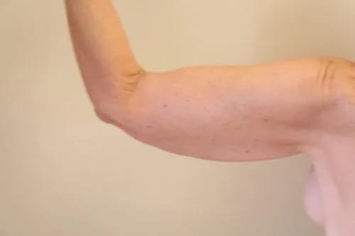 Arm Lift After, Female 44 - 4494