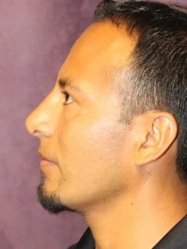 Rhinoplasty After, Male 35 - 4512