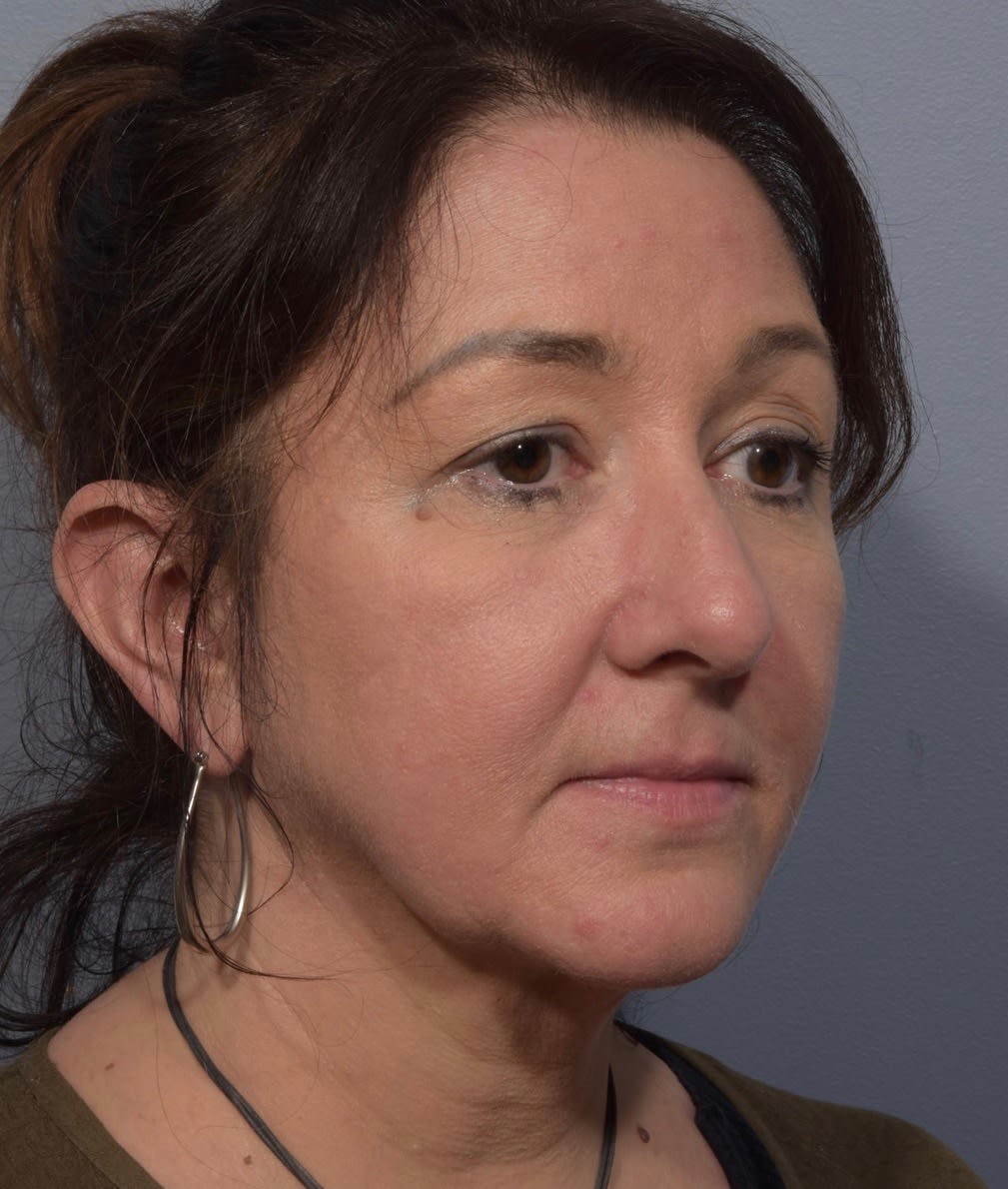 Facial Skin Firming & Lifting Solutions After, Female 46 - 1464