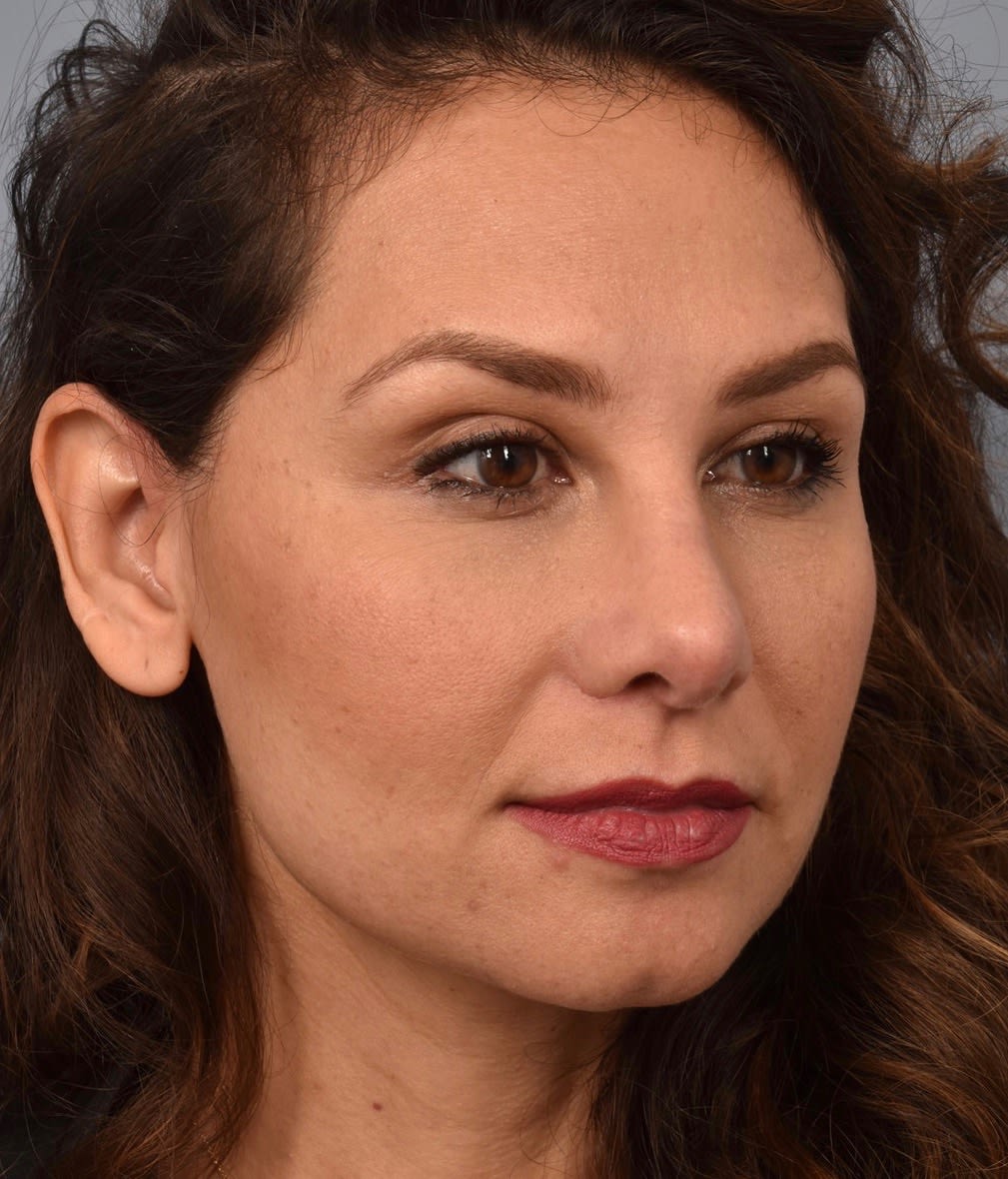 Revision Rhinoplasty After, Female 32 - 1459