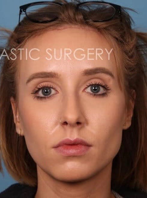 Forehead Reduction After, Female 32 - 1883