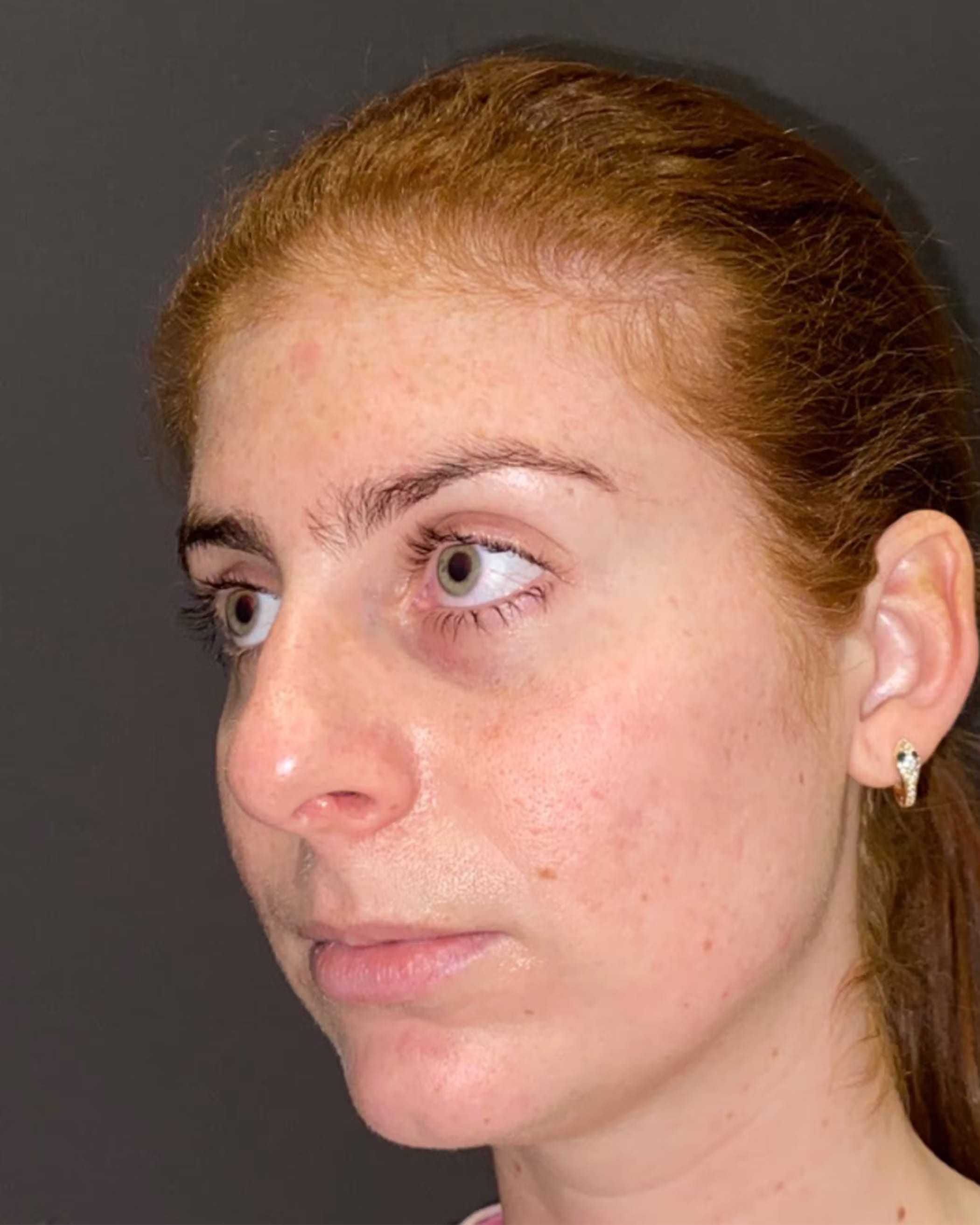 Chin Augmentation Before, Female 29 - 4229