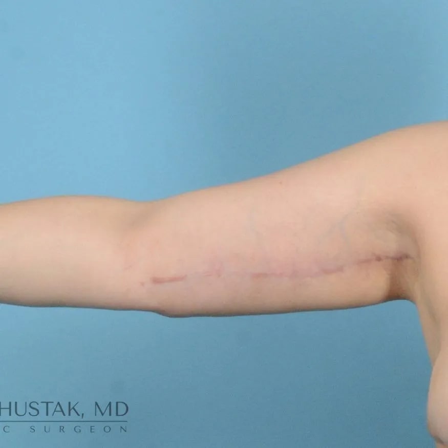 Arm Lift (Brachioplasty) After, Female 41 - 4491
