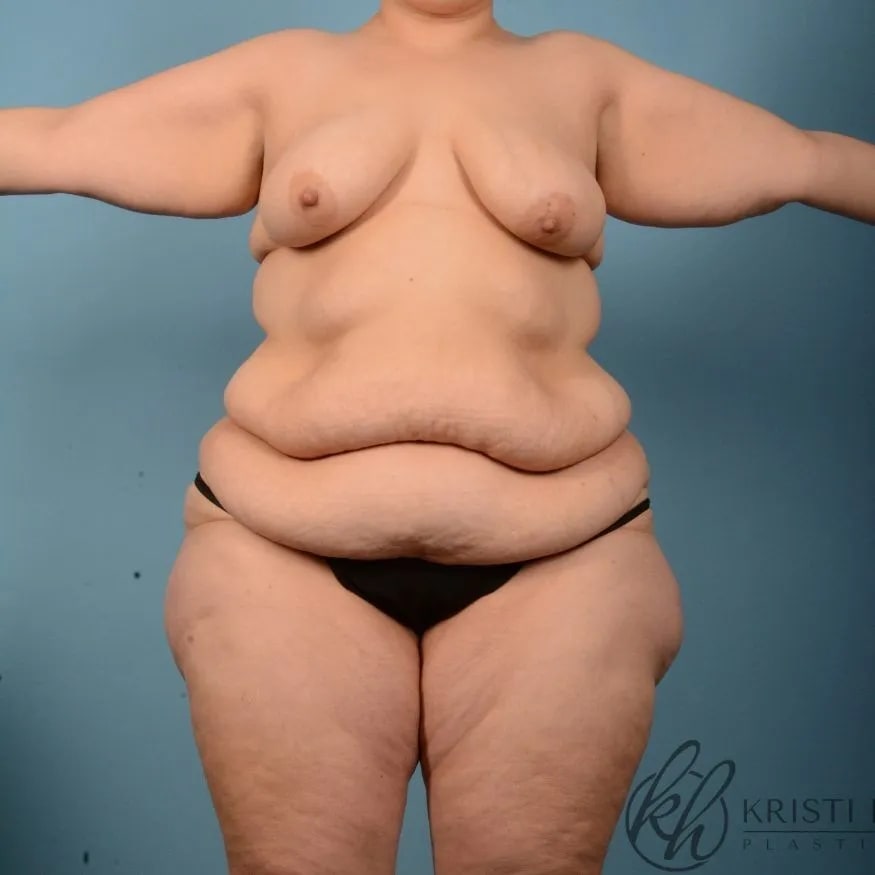 Abdominoplasty Before, Female 41 - 4495
