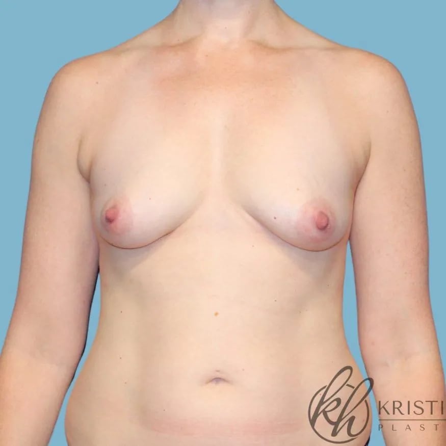 Breast Augmentation (Augmentation Mammaplasty) Before, Female 42 - 4514