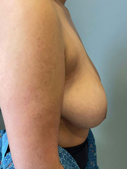 Breast Reduction Before, Female 39 - 4193