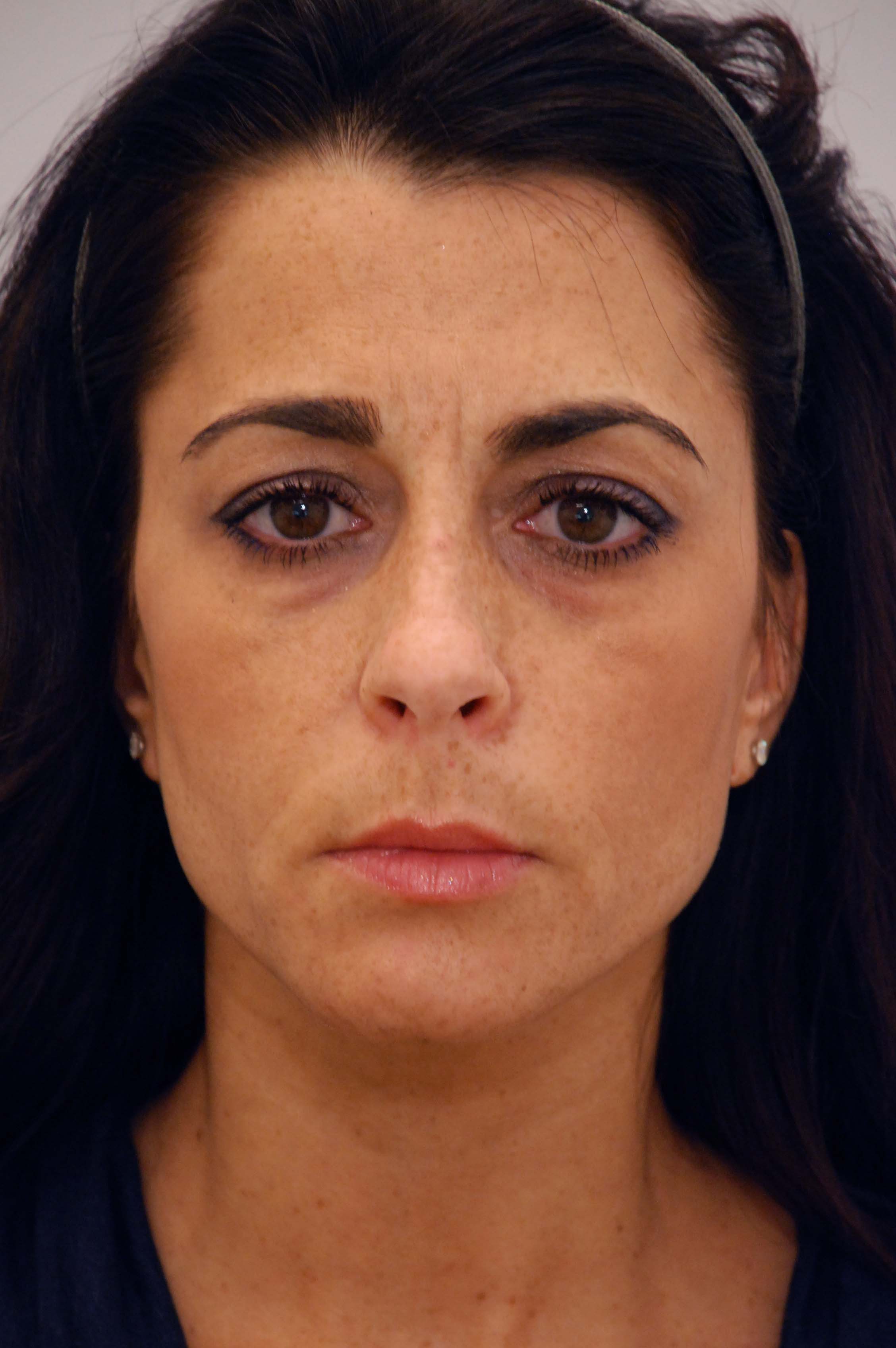 Blepharoplasty Before, Female 41 - 7
